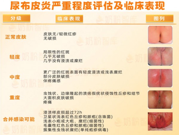 宝宝夏季红屁屁，先别怪纸尿裤！对照最新指南，真正原因是这5个